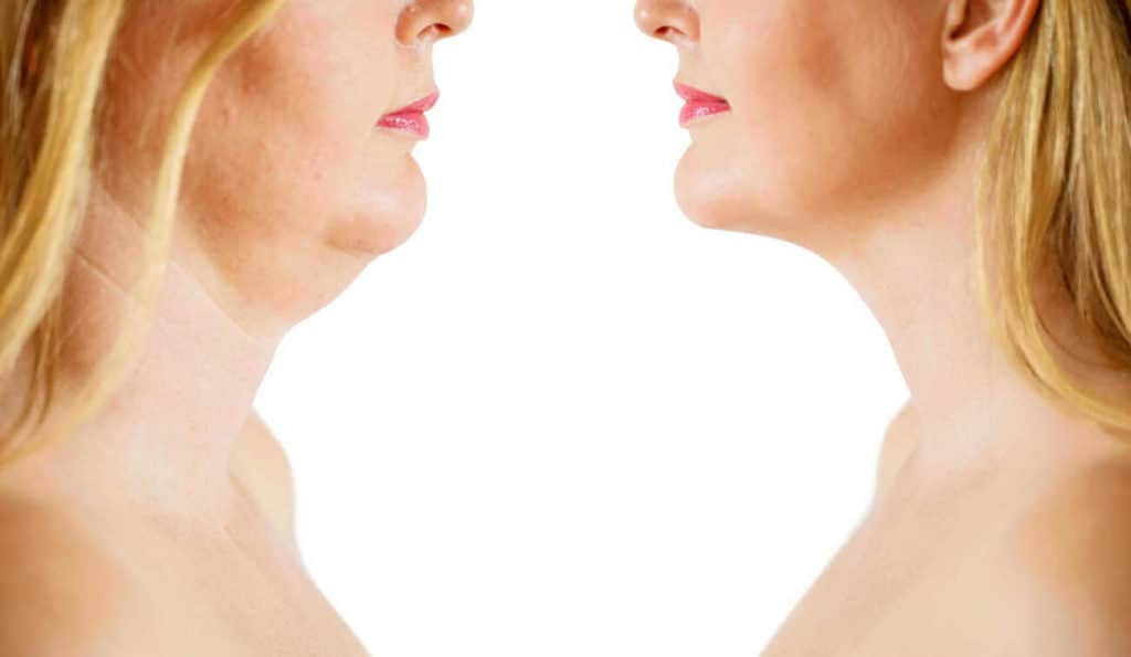 Double Chin treatment West Barnes before and after results