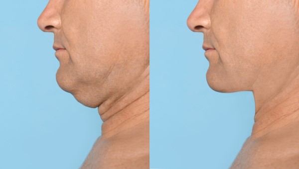 Which Non-Surgical Treatments Work Best for Jowls and Loose Skin West Barnes?