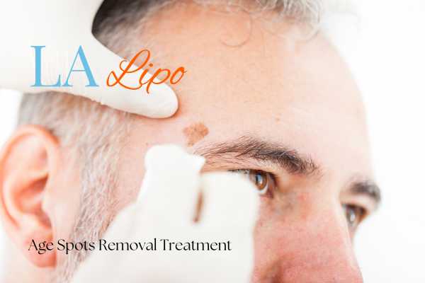 What Are the Most Effective Treatments for Age Spots West Barnes?