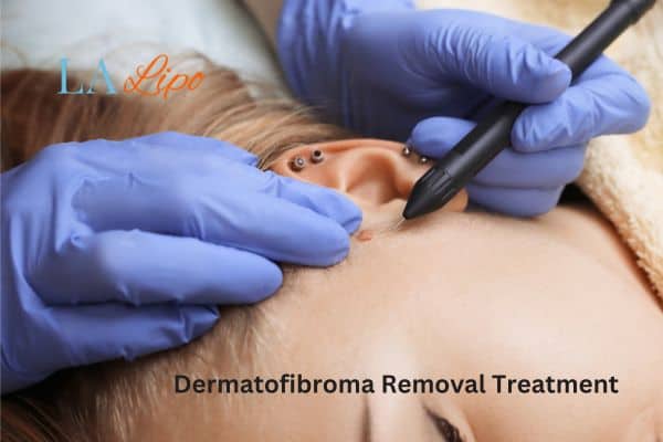 Dermatofibroma Removal Treatment West Barnes