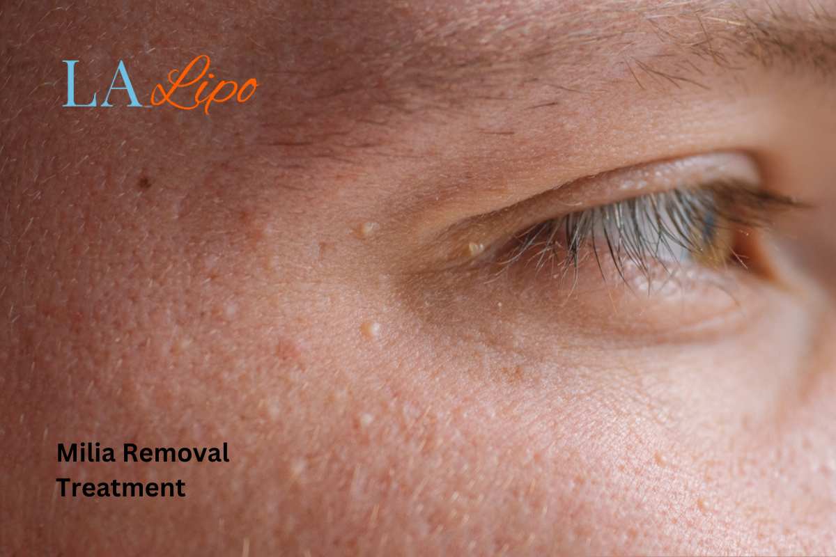 Cryopen Milia Removal: Is It the Easiest and Safest Option West Barnes?