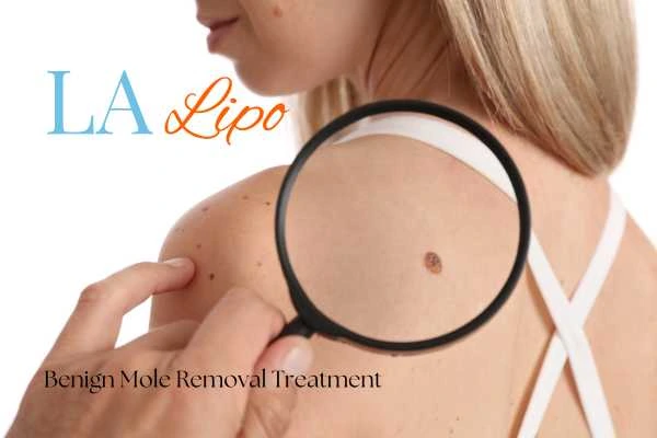 Why getting moles removed West Barnes can boost your confidence!