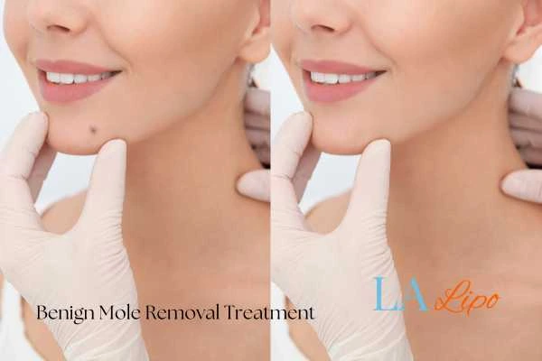 Woman's before and after results of being moles removal treatment West Barnes