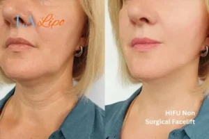 hi-fu for wrinkles West Barnes before and after results