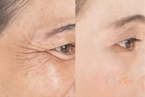 Before and after results of woman - HI-fu wrinkles reduction treatment West Barnes
