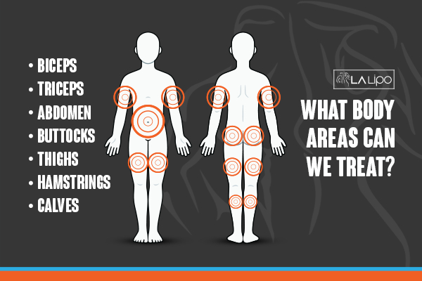 Graphic to show areas you can have LA-EMS Body Sculpting West Barnes treatment.
