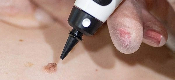 skin tag removal using cryopen West Barnes