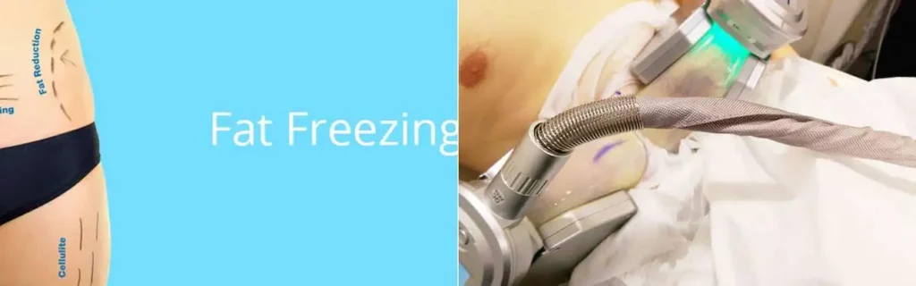 multi areas of a persons body having coolsculpting West Barnes treatment