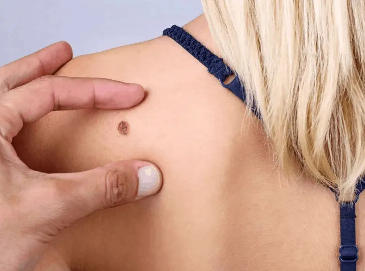 woman having mole removal West Barnes consultation before treatment.