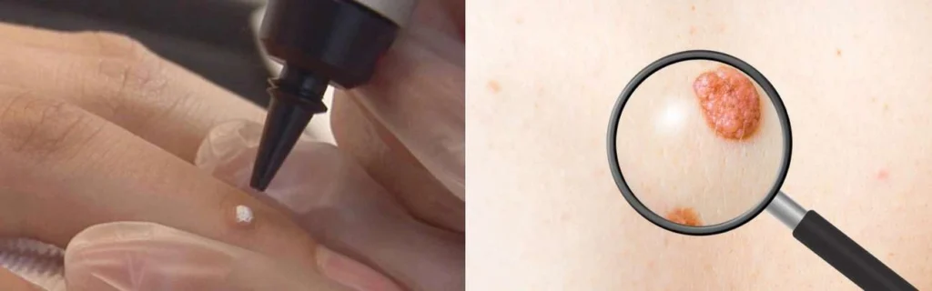 Person getting moles removed with cryopen West Barnes