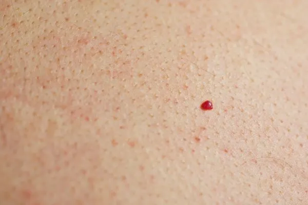 close up of a cherry angioma West Barnes
