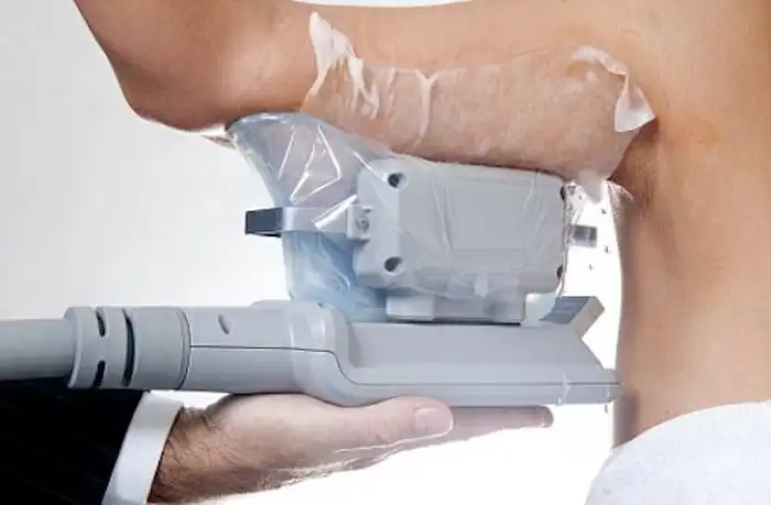 Picture of fat freezing West Barnes on the upper arms.
