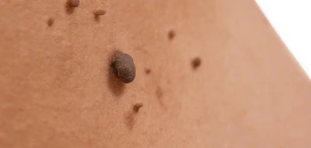 image of a skin tag West Barnes