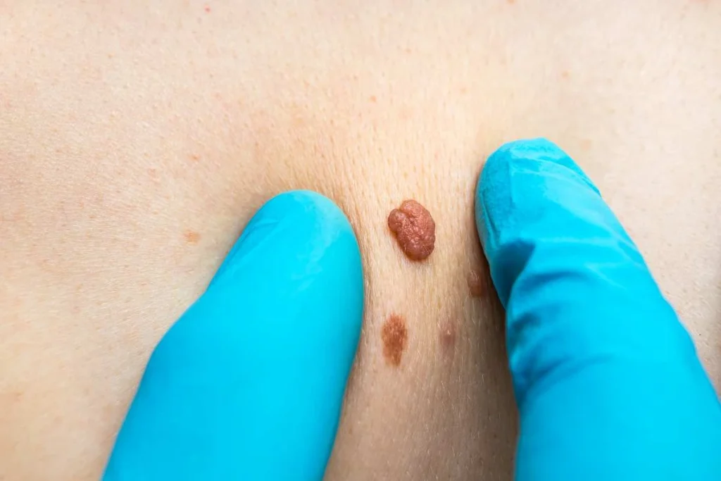 Consultant examining a skin tag West Barnes