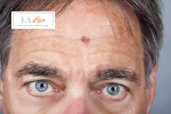Solar Lentigo Removal West Barnes image of man with mark on his forehead