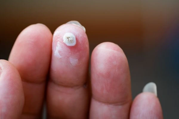 wart on person finger - cryotherapy to treat from LA LIPO West Barnes