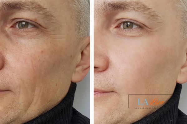 See the amazing results of Morpheus8 Treatment West Barnes!