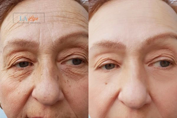 The powerful benefits of Morpheus8 Treatment West Barnes - Call Our team today!