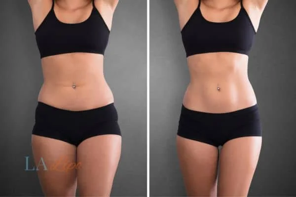 before and after results of non-surgical treatment to help a woman's body image and mental health West Barnes