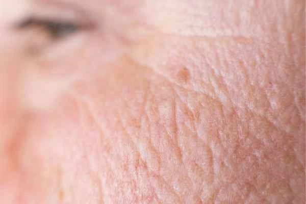 close up picture of a woman's face showing an age spot West Barnes