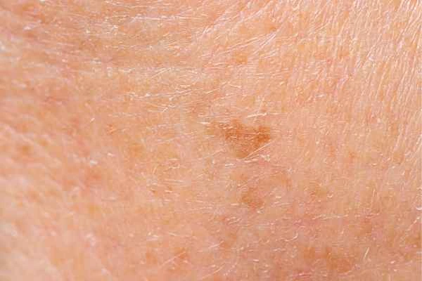 close up picture of age spots West Barnes
