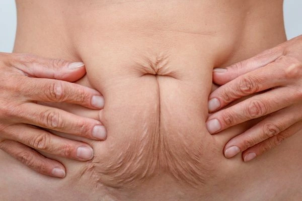 Should I Combine Diastasis Recti Treatment with Body Contouring for Better Results West Barnes?