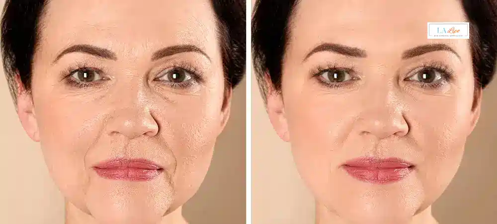 How Long Does It Take to See Results and How Long Do They Last West Barnes?